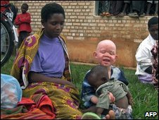 Albino trials begin in Tanzania 