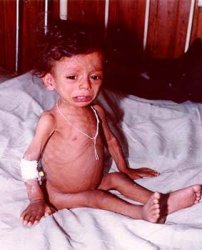 Some 11 people killed in Yemen due to epidemic diseases