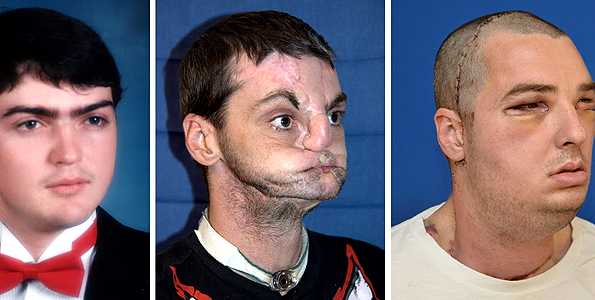 Milestone as man wears donor’s face