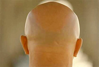 Shower, Faktor Kebotakan Kepala