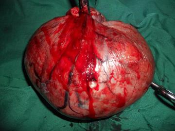 4 Kg Kantong Pelastik di Rahim Gadis 19 Tahun